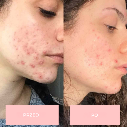 Urządzenie Glow Lane do terapii skóry wysoką częstotliwością